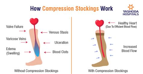 Compression Stocking Benefits