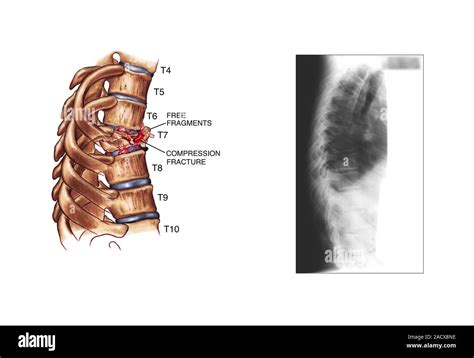 compression thoracic fracture