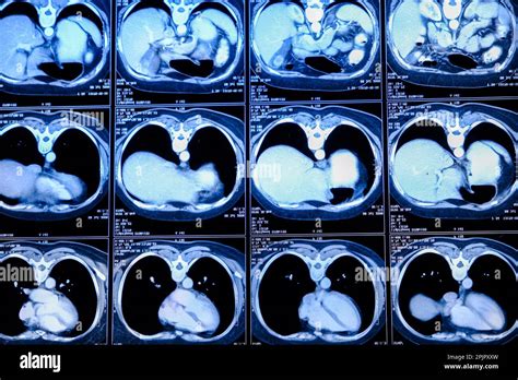What is a Computed Tomography Scan and Its Benefits?