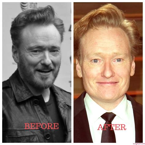 conan o brien plastic surgery