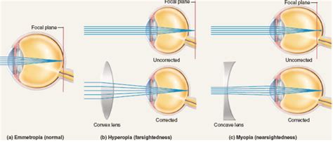 concave and convex lenses for myopia and hyperopia