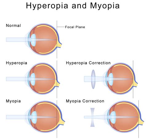 concave and convex lenses for myopia and hyperopia