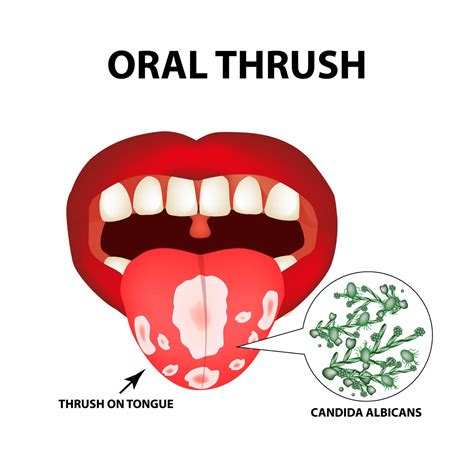 Oral Thrush Diagram