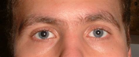 Concussion Anisocoria