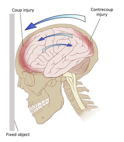 concussion injury of body structure