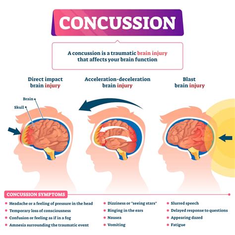 concussion syndrome severe