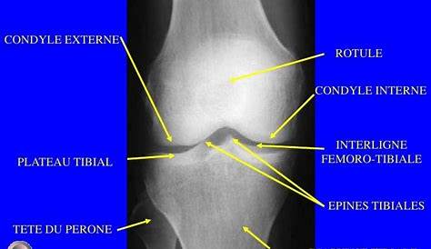 (PDF) Ostéochondrites disséquantes rares du genou chez l