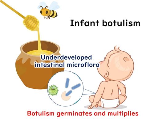 Condensed Milk Botulism