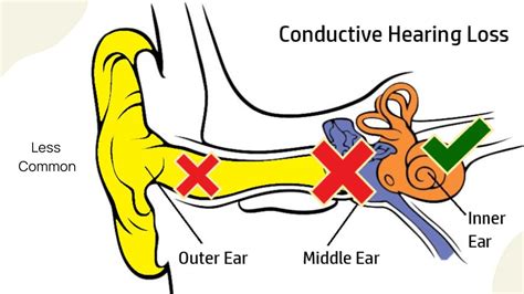 conductive hearing loss definition