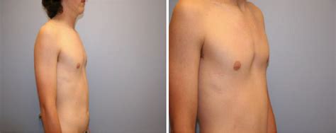 congenital pectus excavatum icd 10