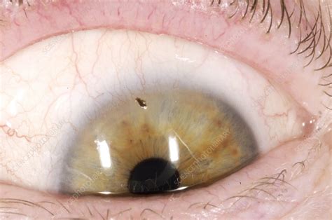 conj foreign body right eye icd 10