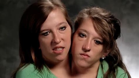 conjoined hensel twins update