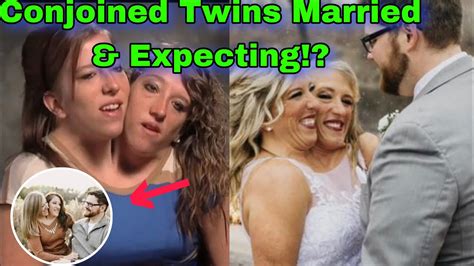 conjoined twins are married