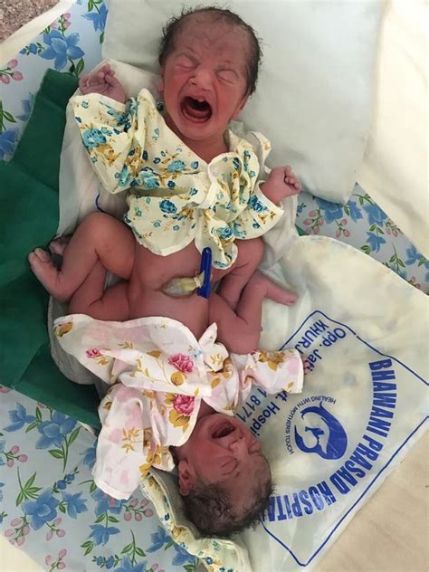 conjoined twins give birth