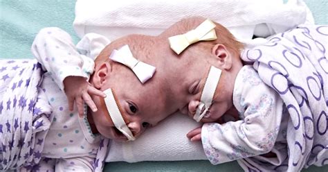 conjoined twins have sad news