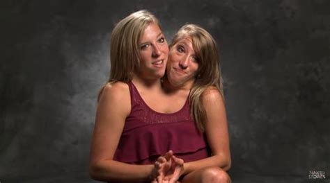 conjoined twins in minnesota