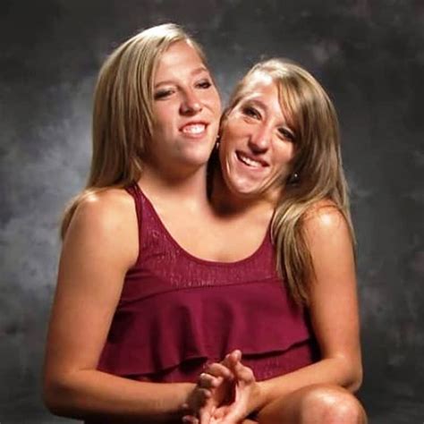 conjoined twins in the world
