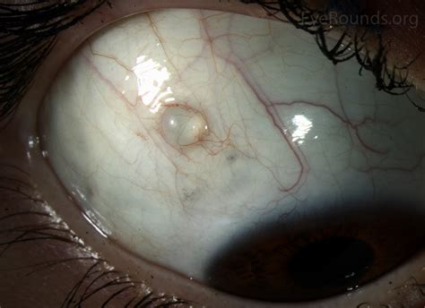 conjunctival cyst