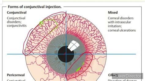 conjunctival injection vs ciliary injection