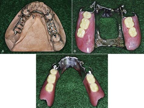 Connector Bar Denture