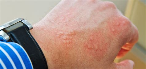 contact dermatitis bruising