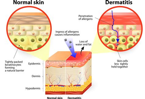 contact dermatitis is an example of a hypersensitivity response