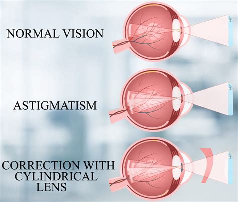contact lenses for astigmatism correction