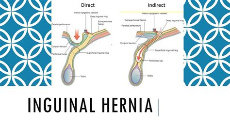 contents of inguinal hernia