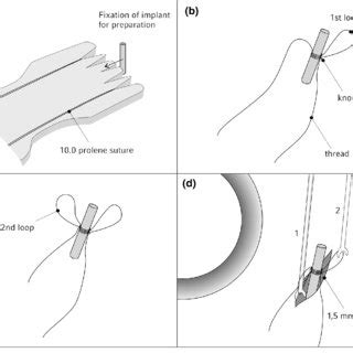 Continuous Loop Anchoring Technique