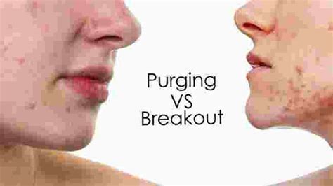 Purging VS Breakout Pratista