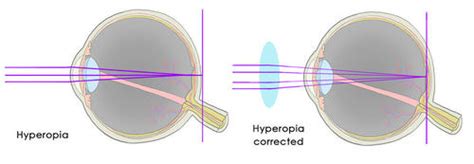Convex Lens Can Be Used To Correct Hyperopia
