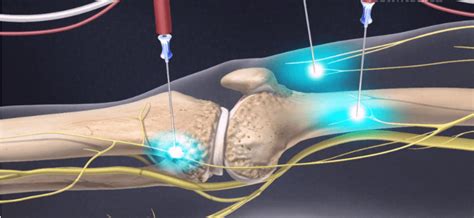 cooled radiofrequency treatment knee