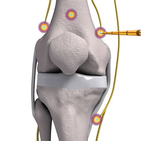 coolief radiofrequency ablation for the knee