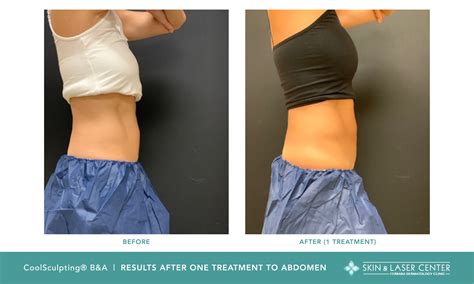 What to Know About Coolsculpting 10 Things About CoolSculpting