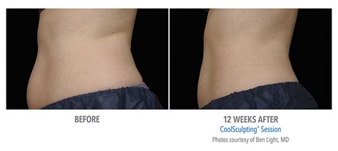 coolsculpting ideal image consultation