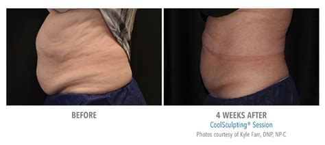 coolsculpting miami before and after