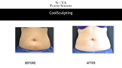 Coolsculpting Vs Plastic Surgery