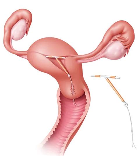 Copper IUD Insertion: What to Expect During the Procedure