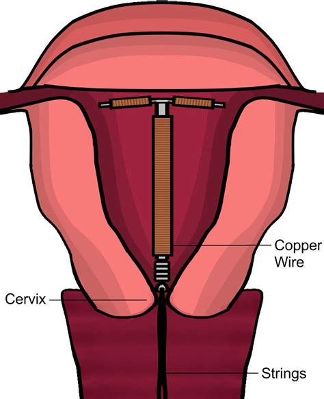 Copper Iud Length