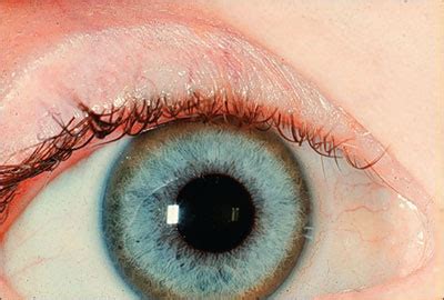 Copper Toxicity Eye Ring