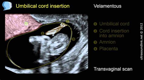 cord insertion icd 10