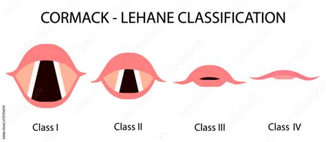 Cormack Lehane System
