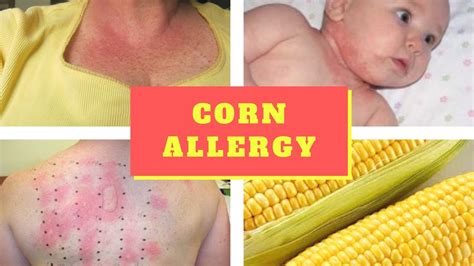 Corn Field Allergy