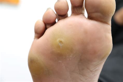 Understanding Corn on Foot: Causes, Symptoms, and Effective Remedies