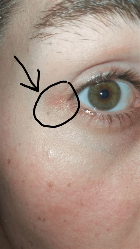 Corner Of Eye Suddenly Red