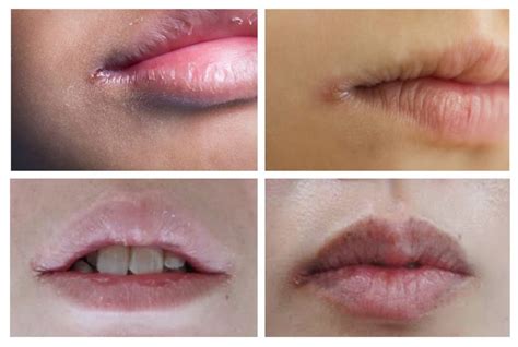 corner of mouth cracking