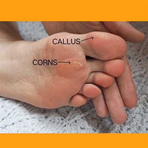 Corns On Tips Of Toes