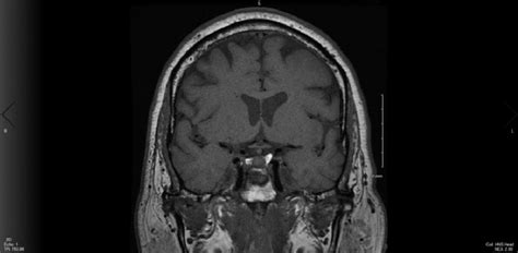 Coronal Cut Mri