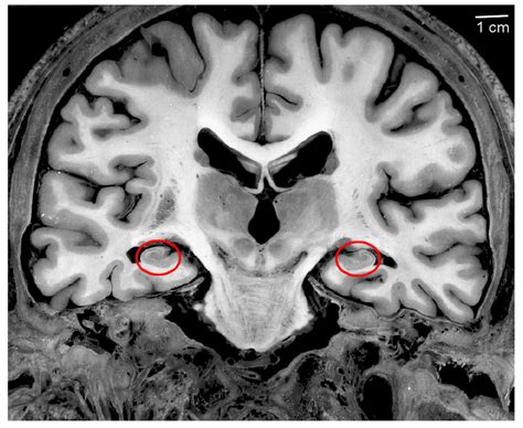 Coronal Mri Hippocampus