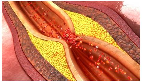 Coronary Artery Disease Plaque Atherosclerosis Cardiology